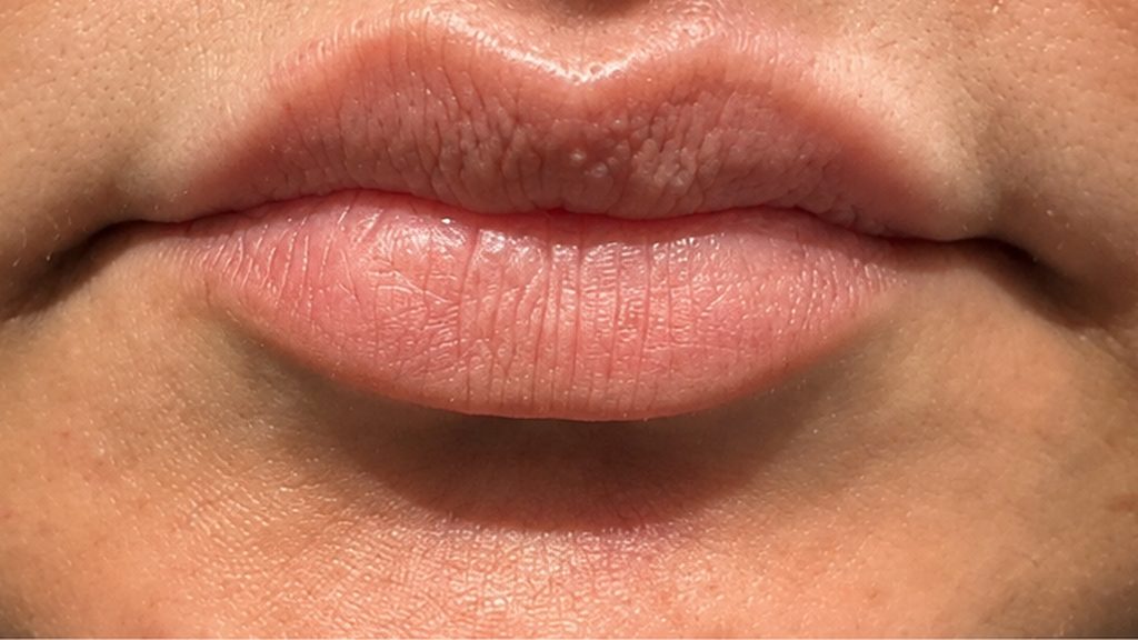 Close-up of a patient's lips before lip filler treatment