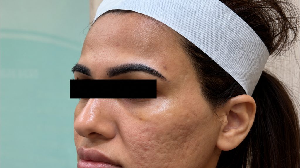Close-up of a patient's cheek with acne scarring, before MNRF treatment