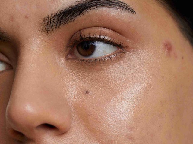 Close-up of a woman&rsquo;s cheek showing acne and scarring before treatment